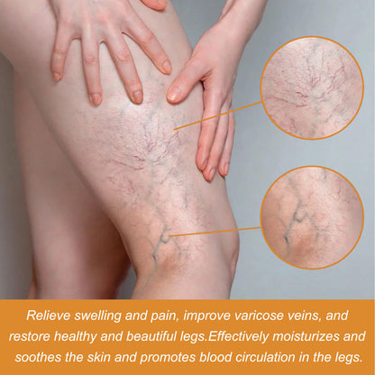 Turmeric Varicose Vein Relief Spray( BUY 1 GET 2 FREE💥 🎁  )